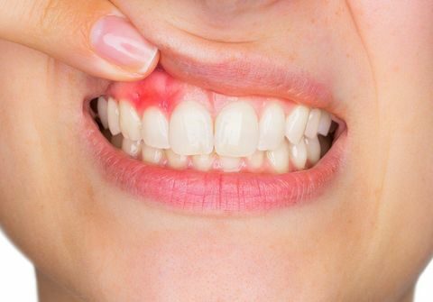 How to Reverse Gum Disease